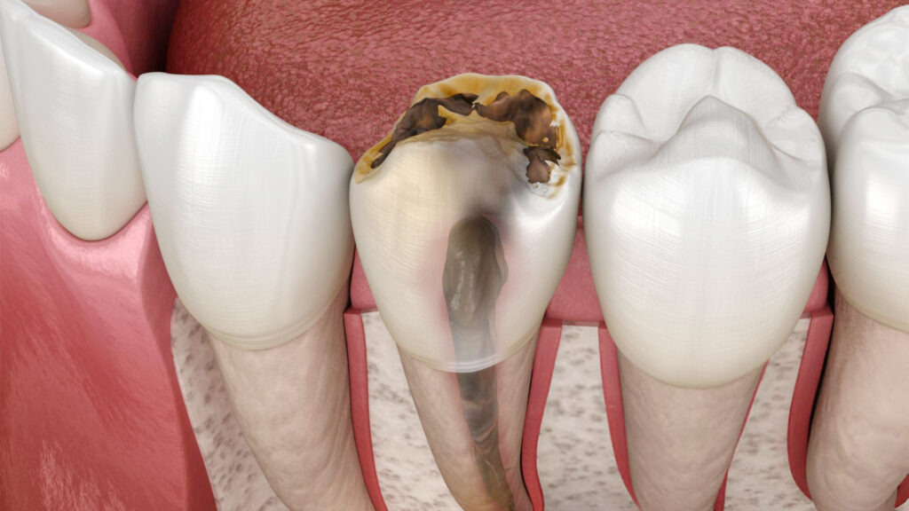Tooth Infection