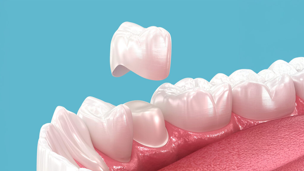 Dental Crowns