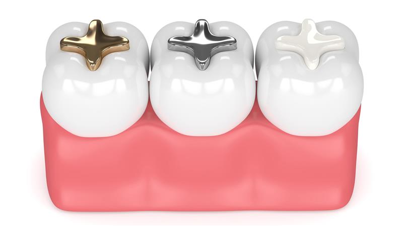 Dental Filling