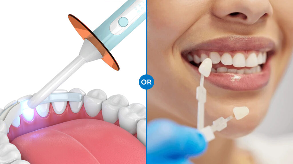 veneers