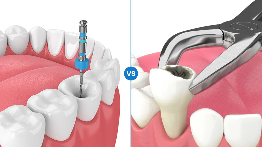 Root Canal