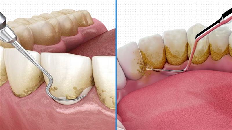 Plaque vs. Tartar
