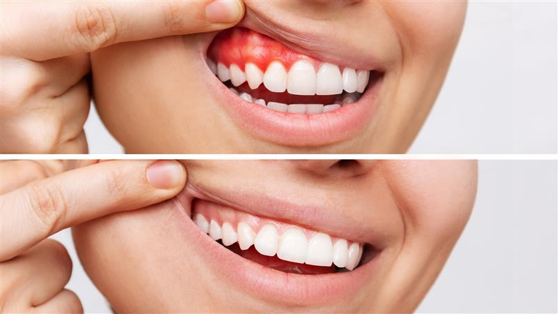 Gum disease