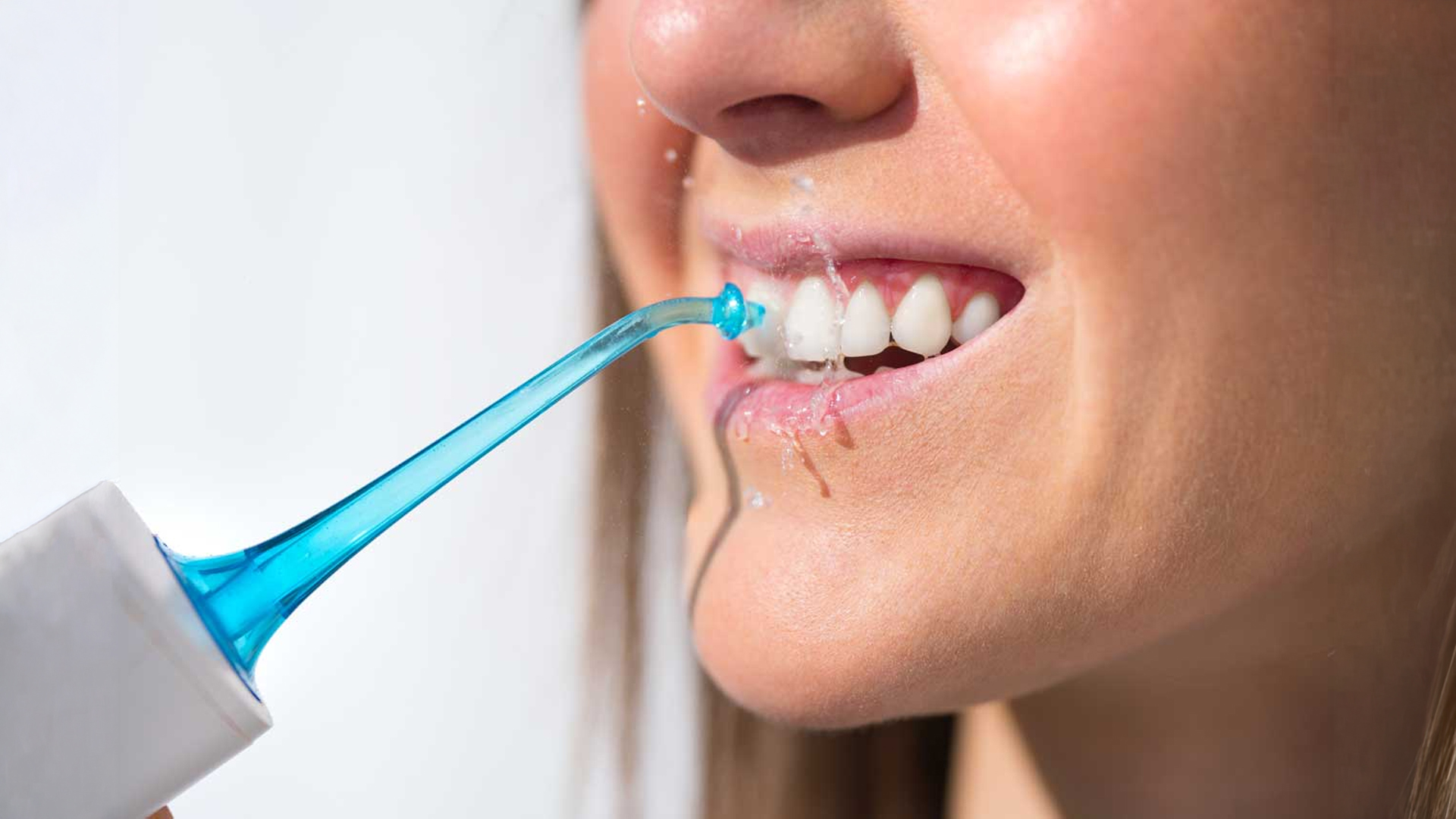 fluoride treatment