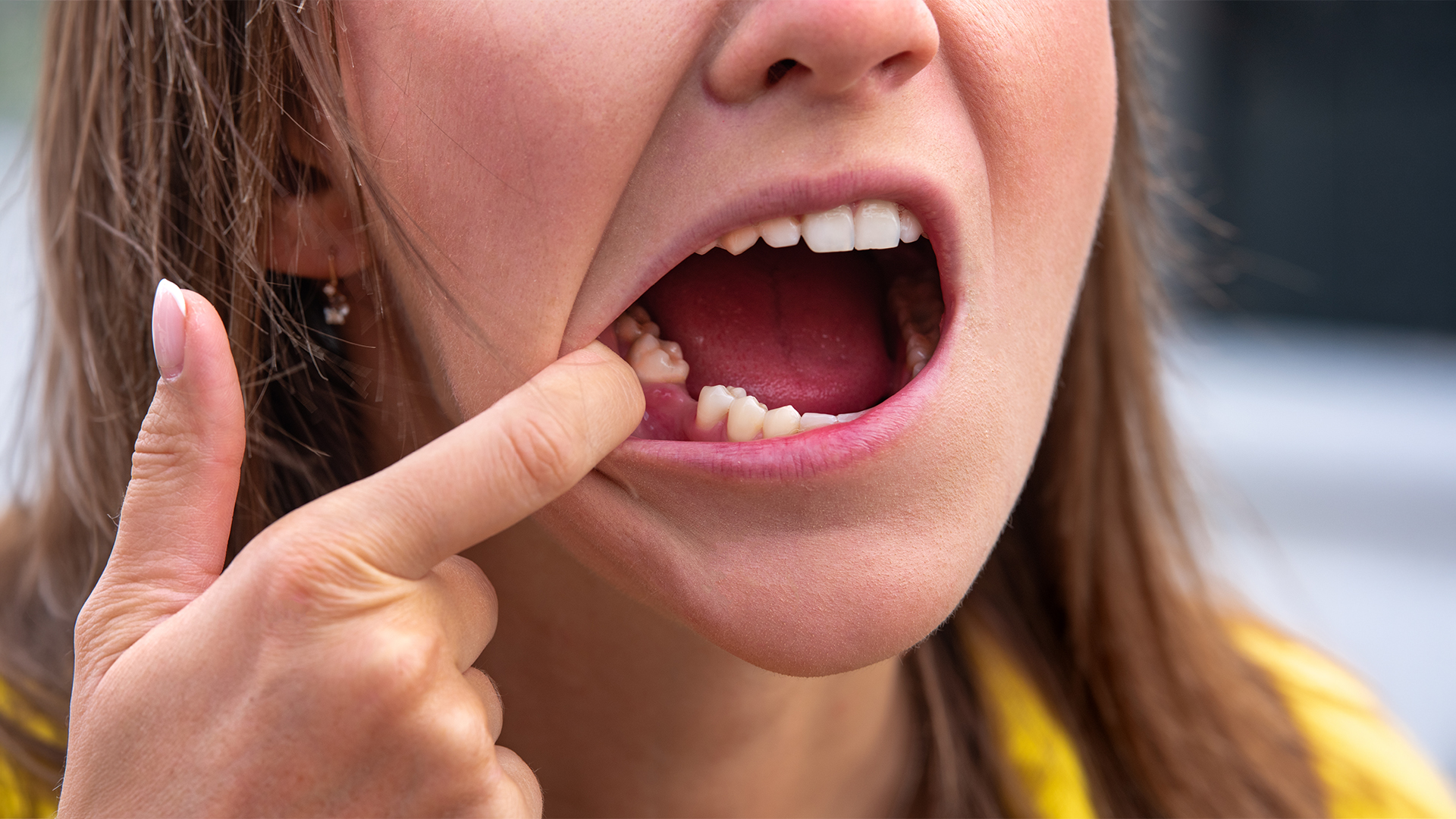 Tooth replacement